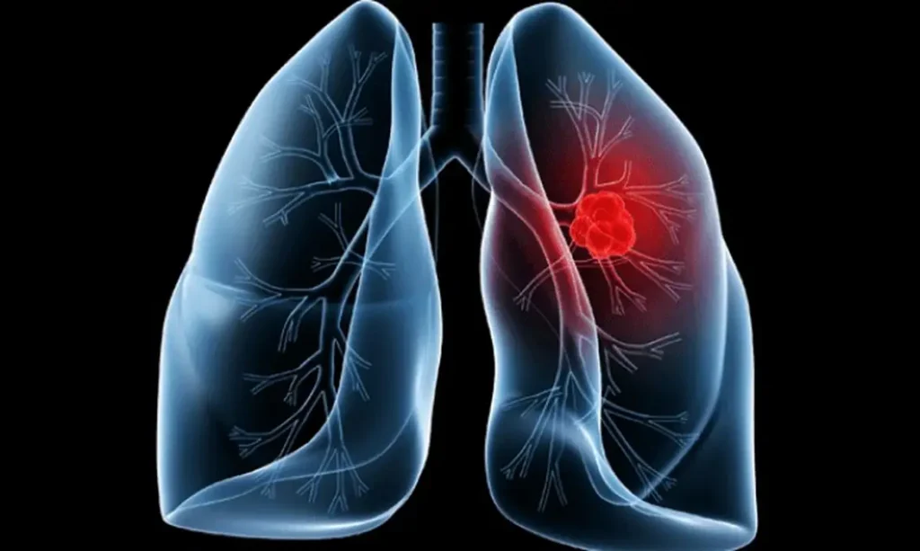 Cancer-de-pulmao-Agencia-Brasil-1024x613 Saiba o que é adenocarcinoma pulmonar, câncer que atinge o Papa